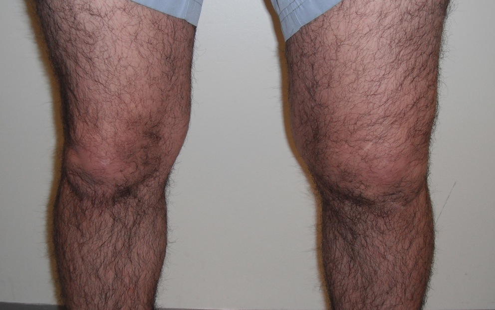 Inflammatory Arthritis Knee
